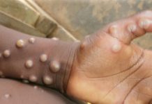 Togo : 350M FCFA pour une meilleure prise en charge des maladies cutanées