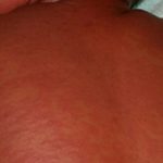 Rougeole : Blitta et l’Ogou basculent en épidémie