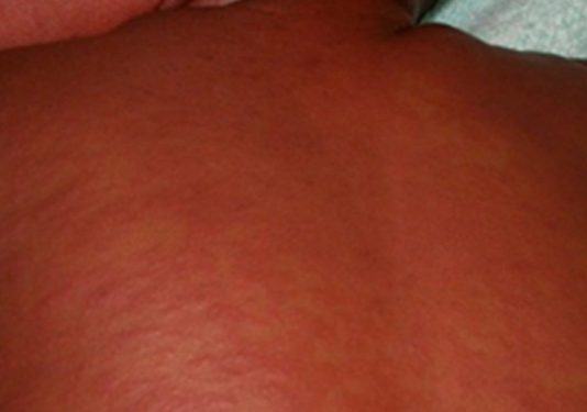 Rougeole : Blitta et l’Ogou basculent en épidémie